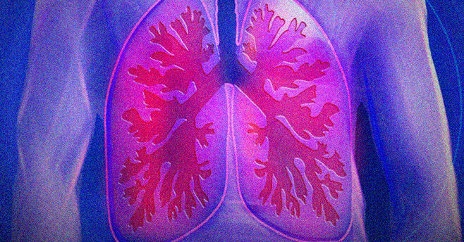 L'intelligenza artificiale di Google è in grado di rilevare il cancro ai polmoni col 97% di successo
