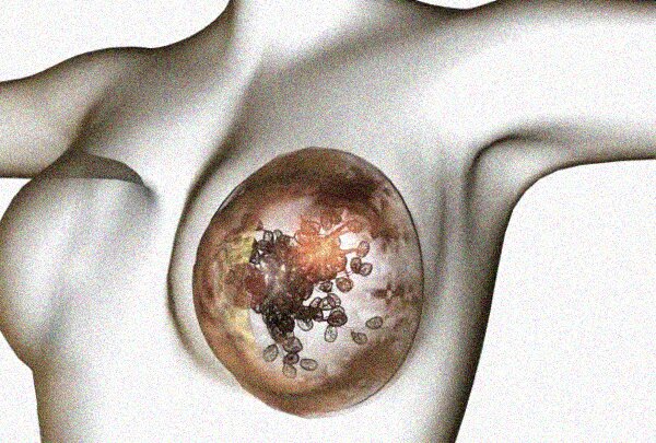 Un farmaco per l'osteoporosi si è rivelato molto utile contro le recidive del cancro al seno