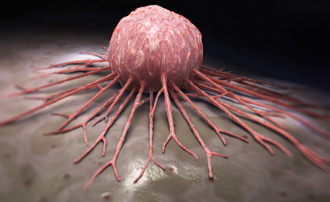 Cancro alla cervice uterina