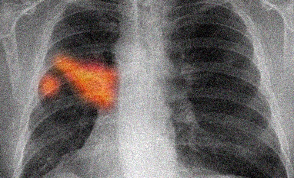 Google e la sua IA hanno fatto passi avanti decisivi nel diagnosticare il cancro ai polmoni