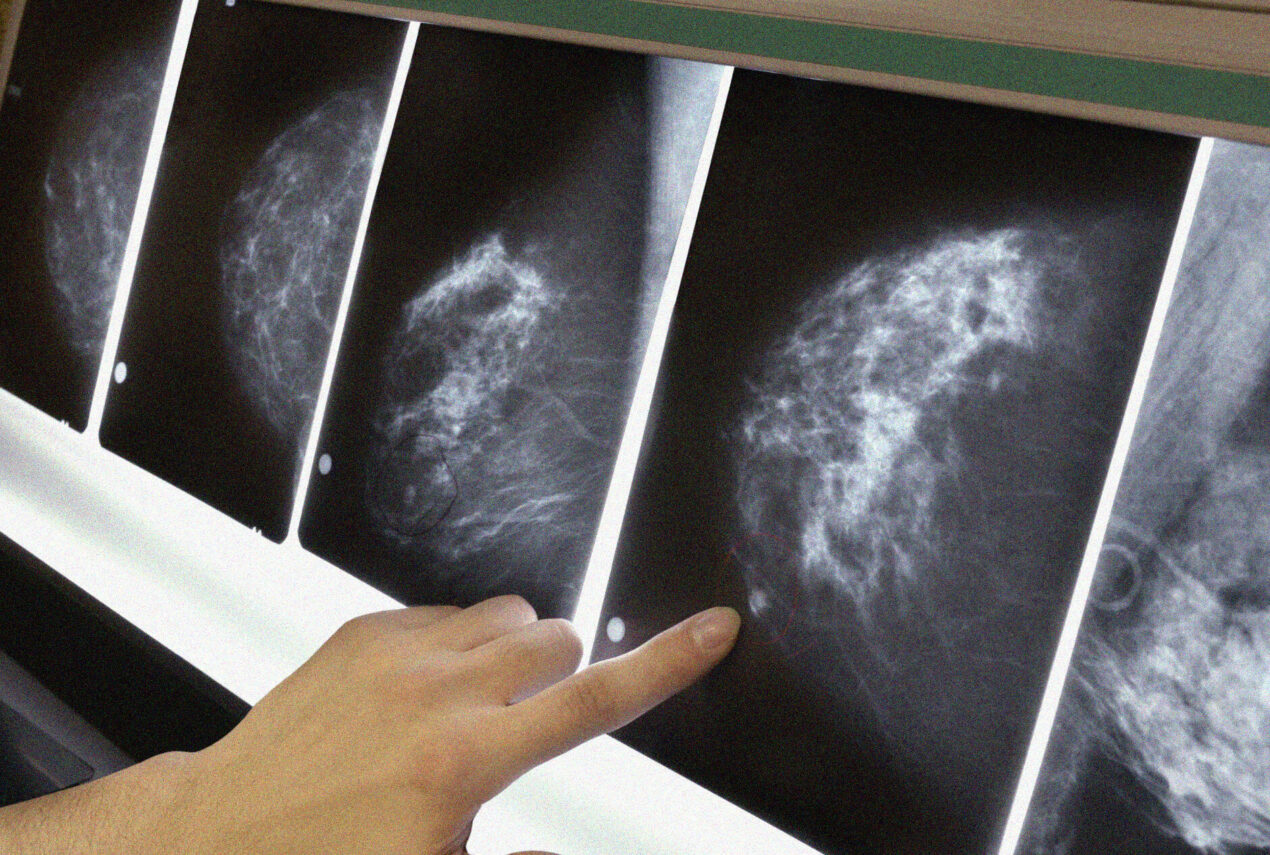 La nuova IA del MIT è incredibilmente effiace nel predire un cancro al seno