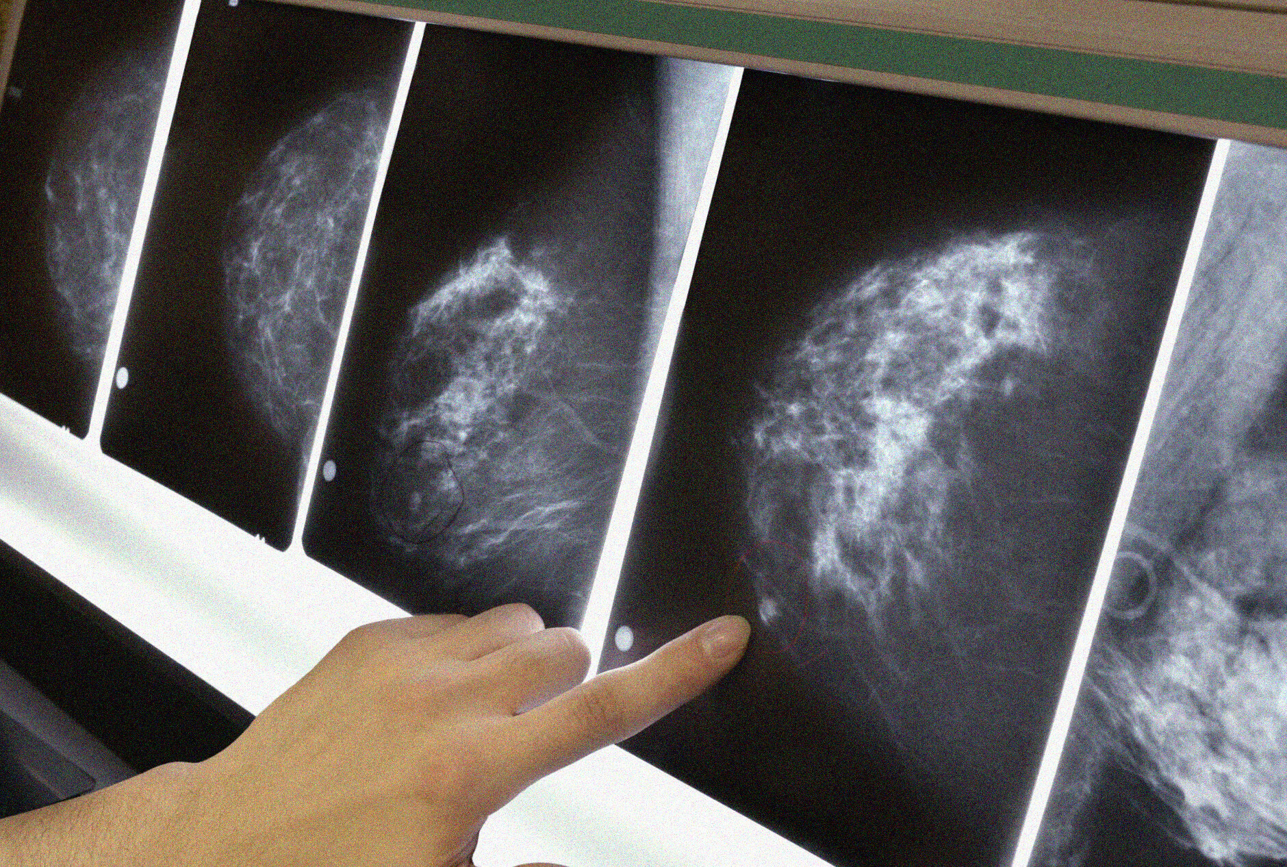 cancro al seno