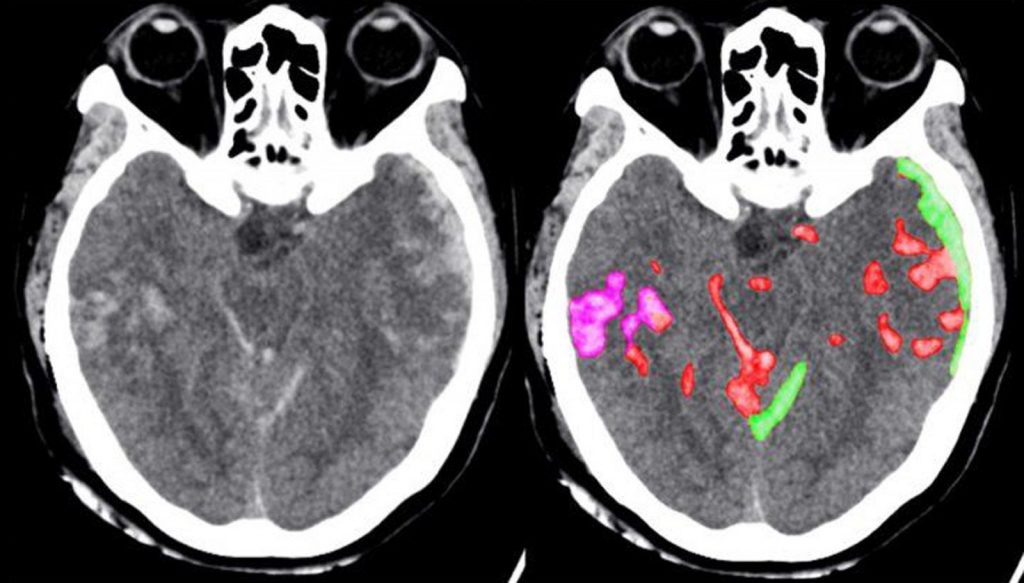 Intelligenza artificiale aiuta i dottori nella diagnostica delle emorragie