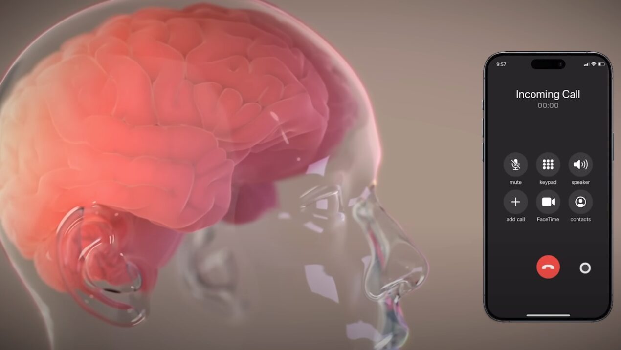 Il primo impianto Neuralink installato nel cervello di un essere umano
