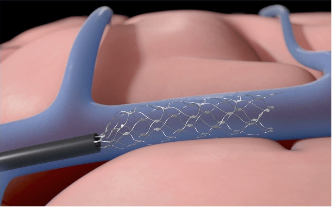 apple controllo mentale dispositivi stentrode